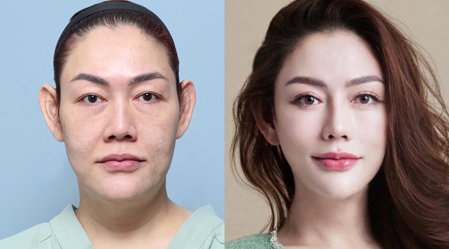 3D facial contouring surgery before and after result