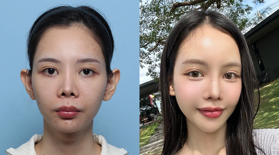 Thread lift and facial rejuvenation transformation